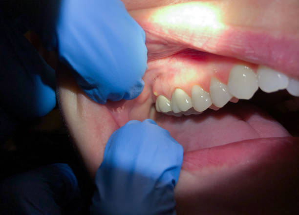 Best Emergency Dental Care for Abscessed Tooth in Warwick, RI