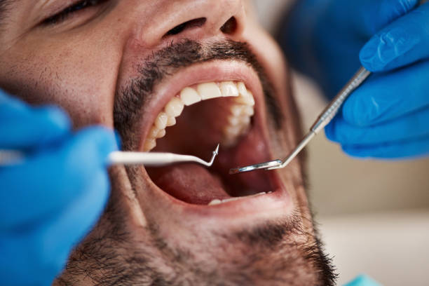 Best Emergency Dentist for Lost Fillings or Crowns in Warwick, RI